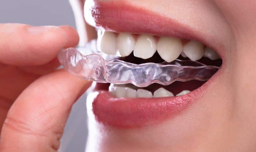 Invisalign Aligners