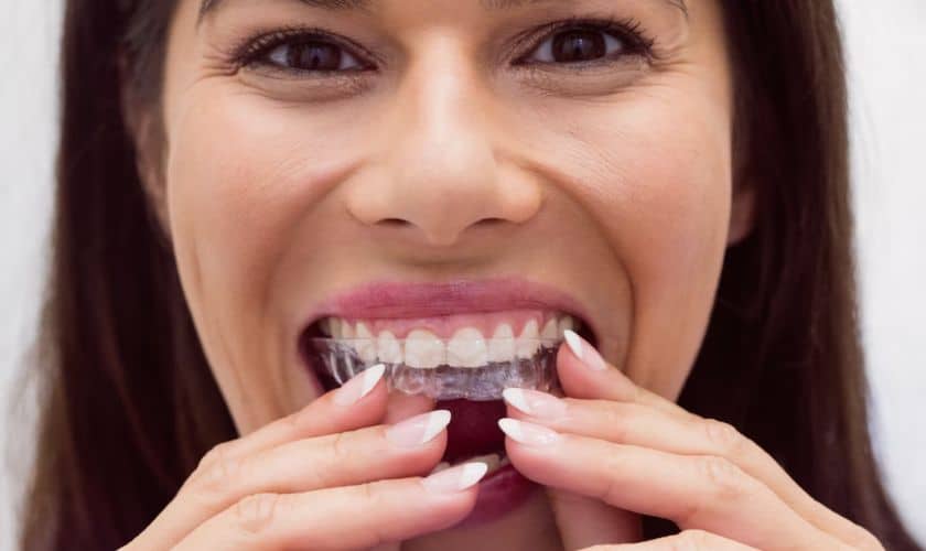 Invisalign Aligners