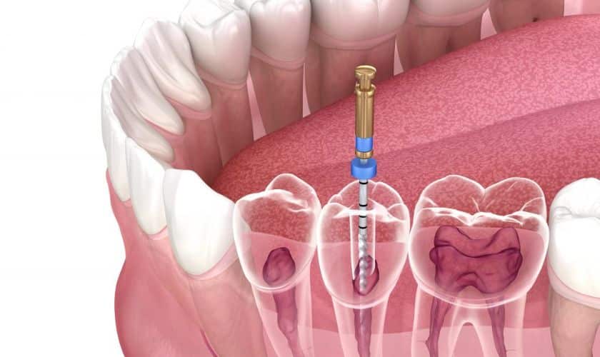 Root canal