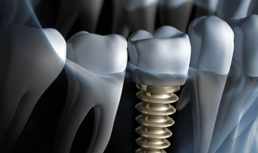 Dental Implants in Pasadena CA