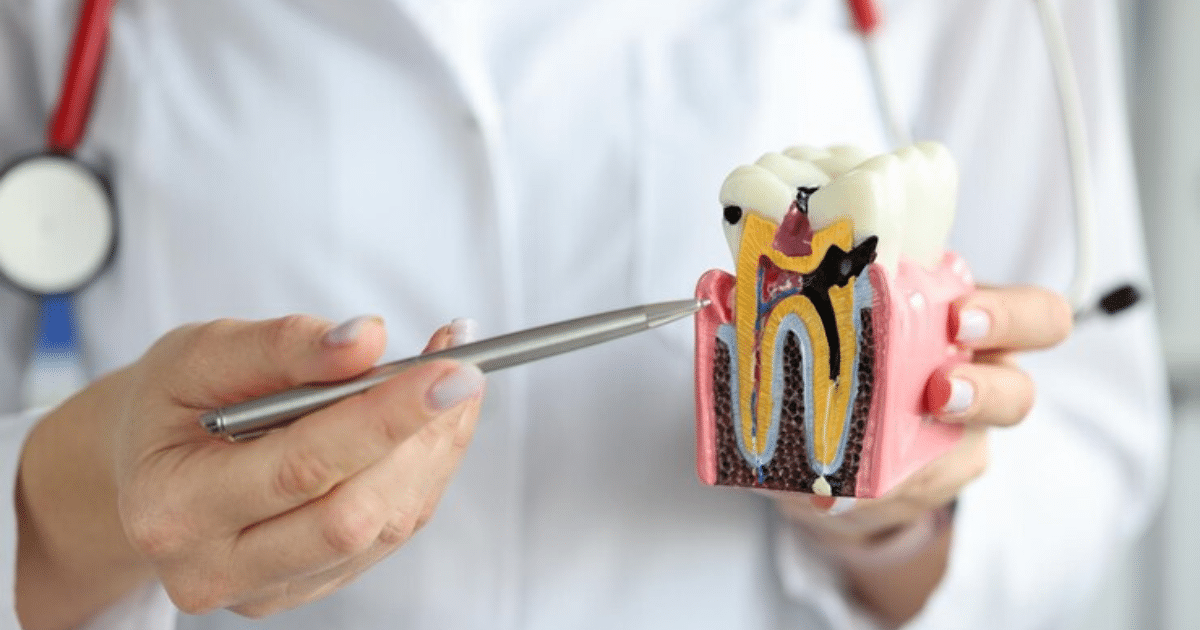 Root Canal Therapy