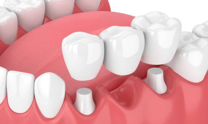 Same-Day Dental Crown in Pasadena CA