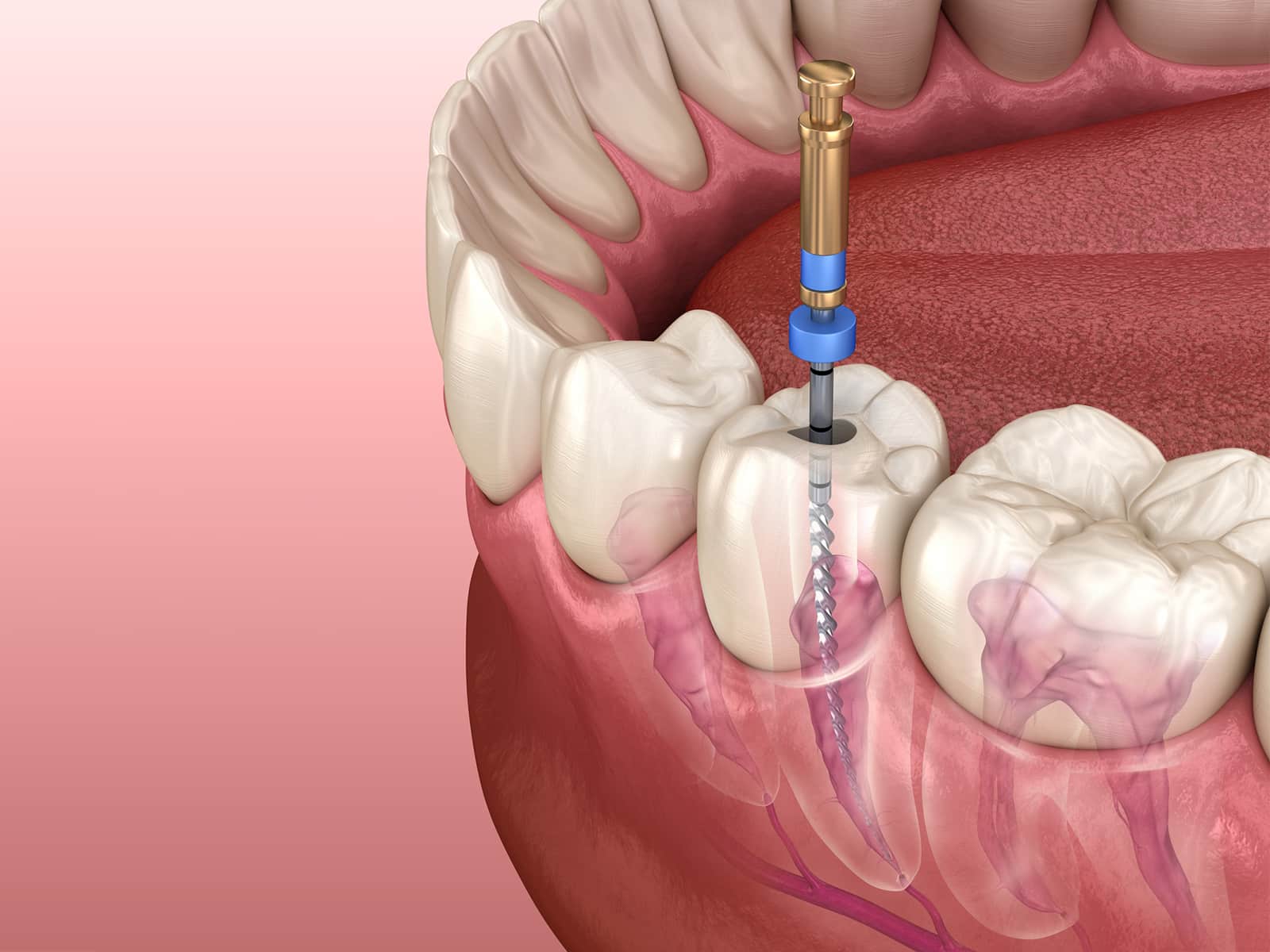 understanding-how-long-a-root-canal-takes-to-heal