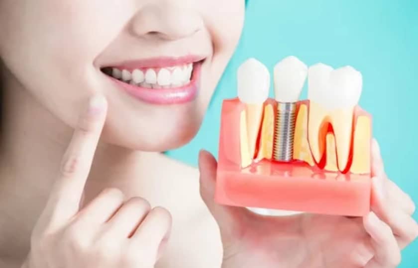 Dental-implants Look Amazing