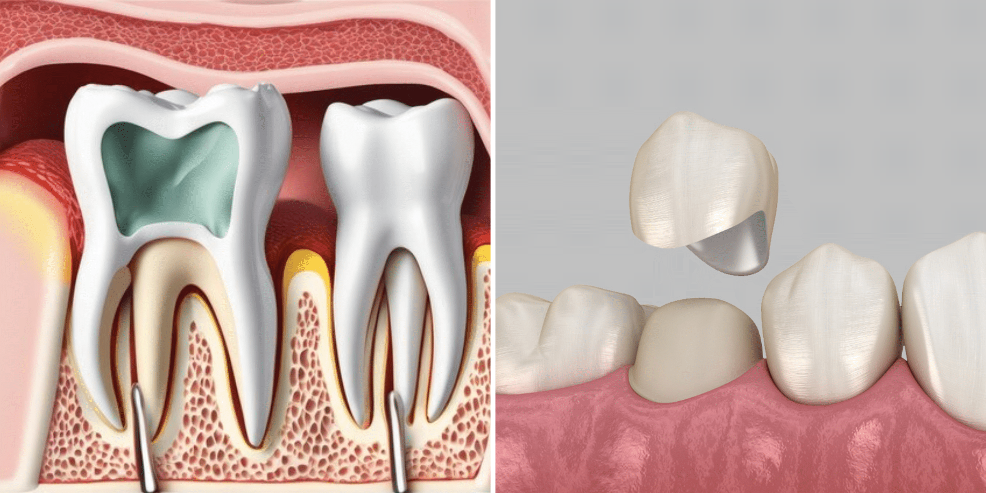 can you get a root canal and crown in the same day