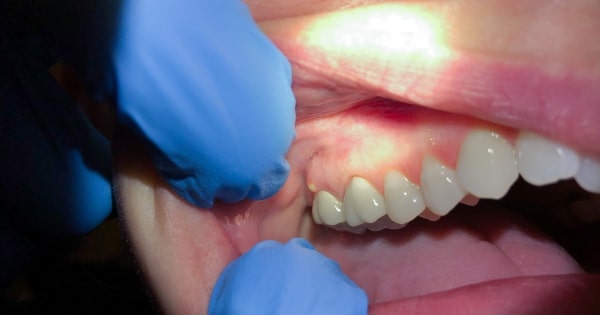 top causes of dental emergencies in pasadena and how to avoid them