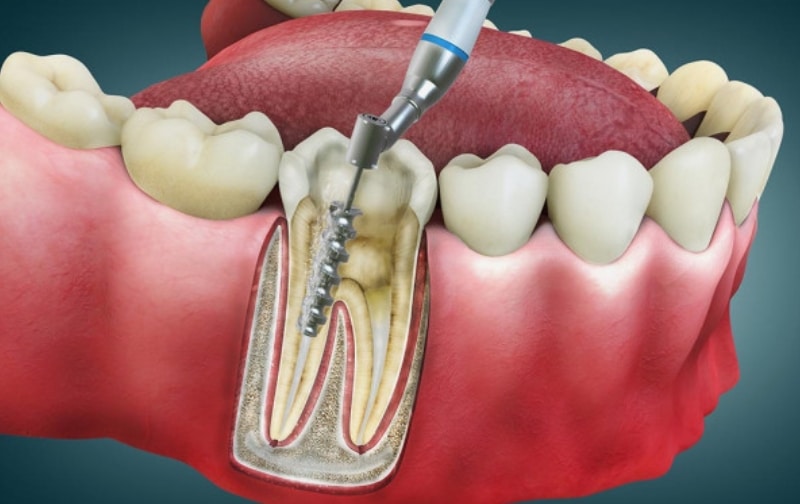 Root Canal Therapy in Pasadena
