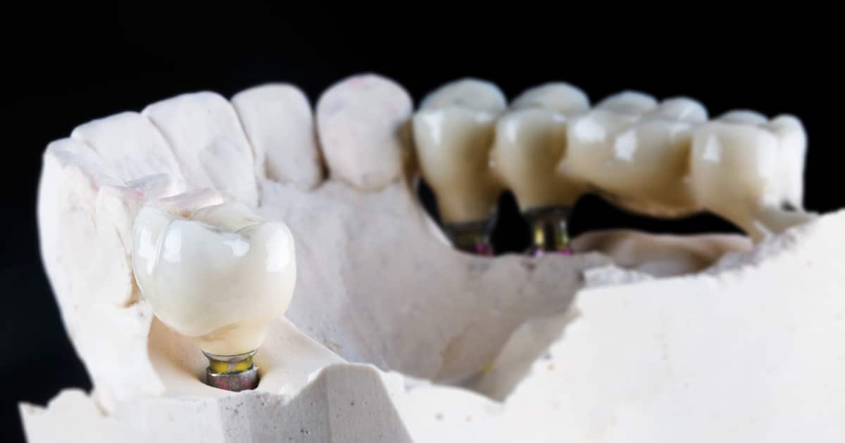 functional benefits of dental bridges