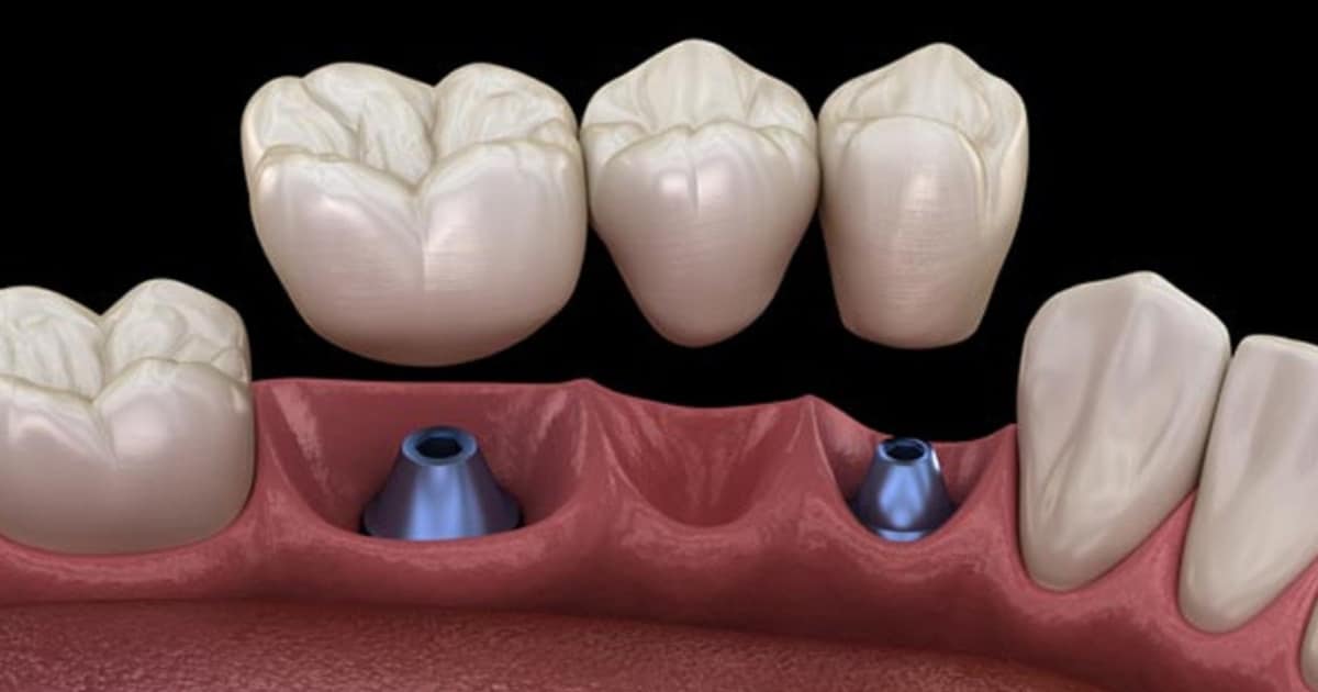 Can Dental Implants Be Done Without Bone Grafting